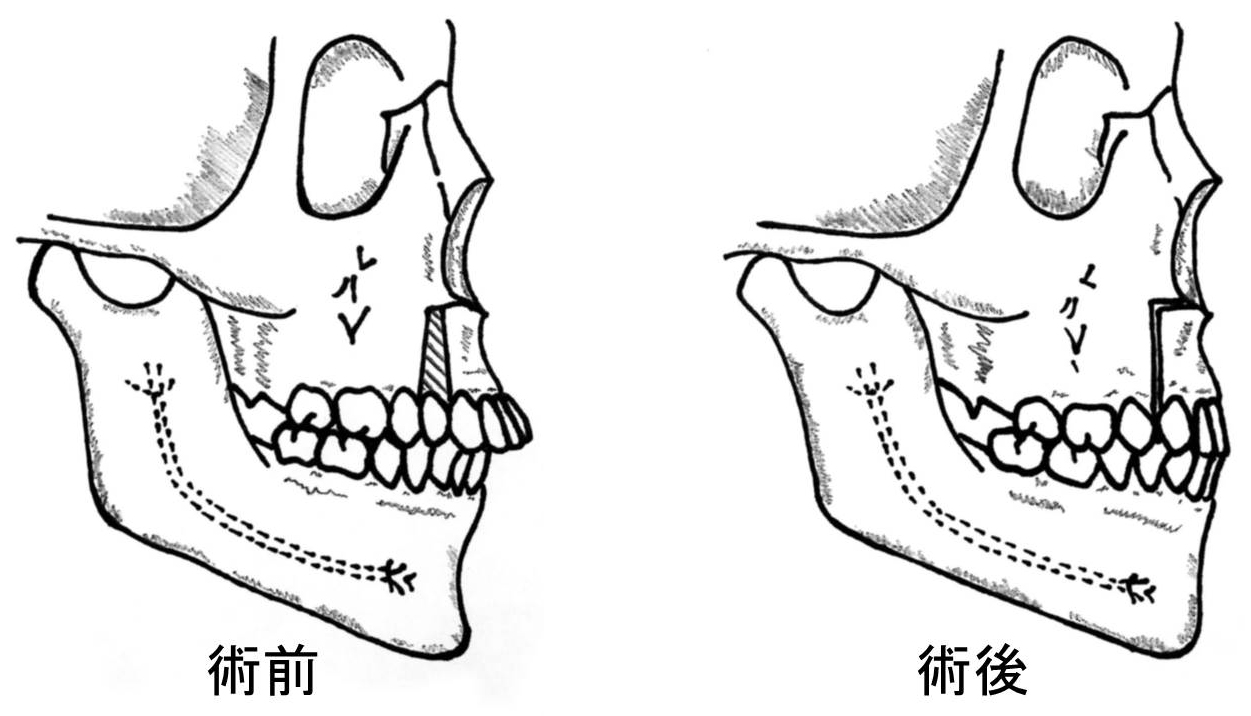 顎変形症4