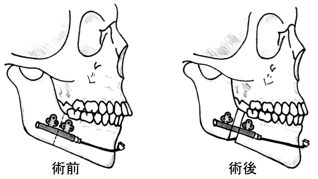 顎変形症5