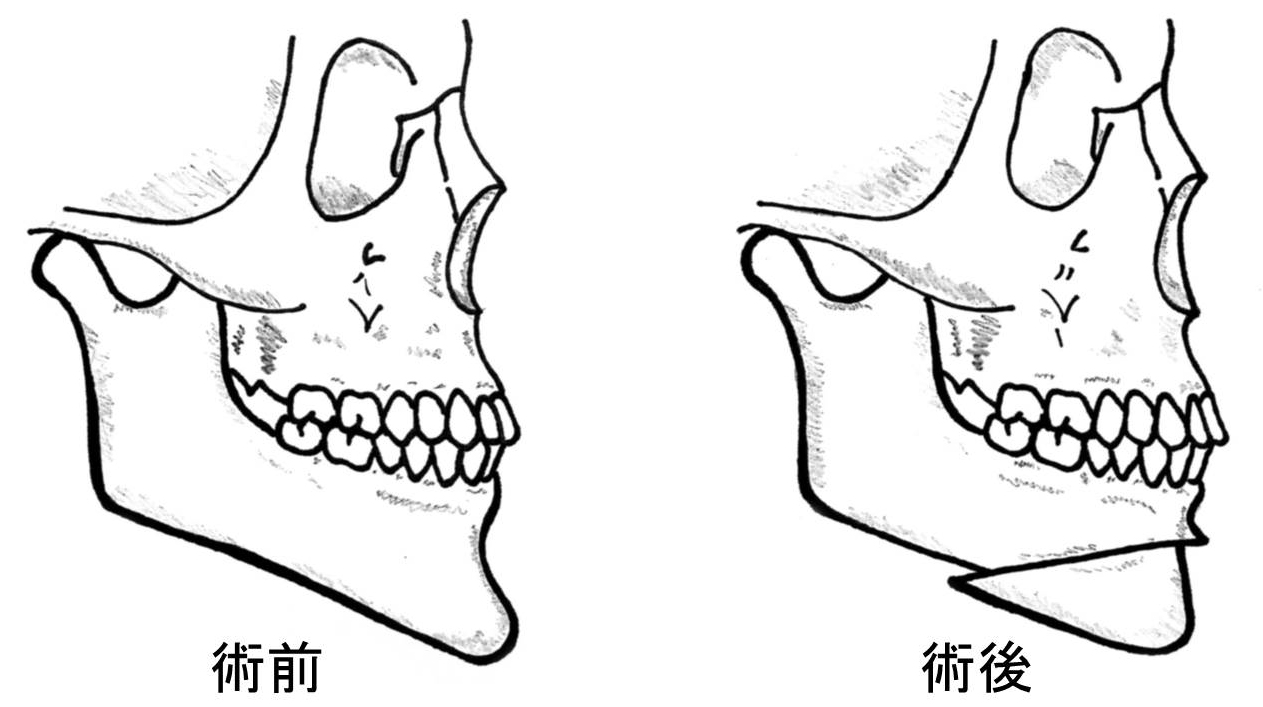 顎変形症6