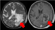 脳腫瘍（左：造影剤なし　右：造影剤あり）