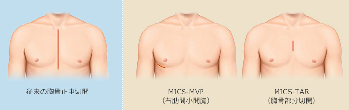 従来の胸骨正中切開／MICS-MVP（右肋間小開胸）／MICS-TAR（胸骨部分切開）