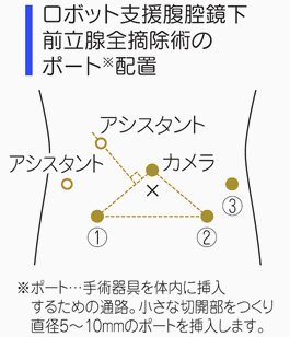 ロボット支援腹腔鏡下前立腺全摘除術のポート配置