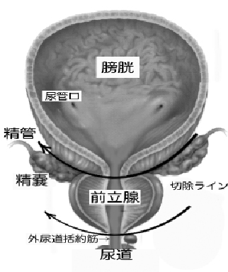 限局性前立腺がんのリスク分類