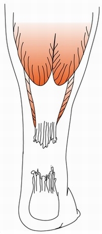 アキレス腱の図 断裂後