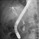 内視鏡的逆行性胆管膵管造影