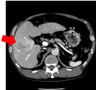 肝腫瘍（造影剤使用）