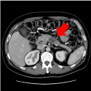 膵腫瘍（造影剤使用）