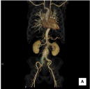 腹部大動脈CTA（大動脈瘤）