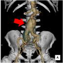 腹部大動脈CTA（大動脈瘤）