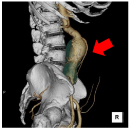 腹部大動脈CTA（大動脈瘤）