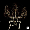 脳血管3DCTA（脳動脈瘤）