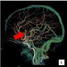脳血管3DCTA（脳動脈瘤）