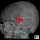 脳血管3DCTA（脳動脈瘤）