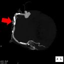 冠動脈3DCTA(狭心症)