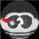 肺腫瘍