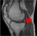 膝関節（半月板損傷）