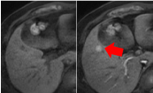 肝腫瘍（左：造影剤なし 右：造影剤あり）