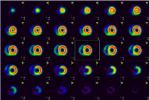 （図１）　心筋血流シンチグラフィ