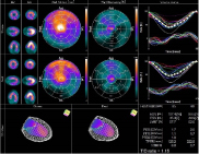 （図2）心電図同期心筋血流シンチグラフィ