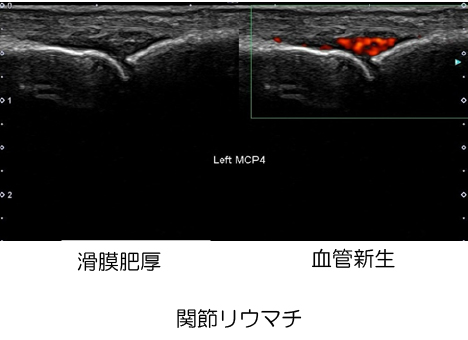 関節超音波検査