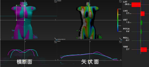 Voxelan（青線：治療計画時の輪郭　紫線：実際の輪郭）